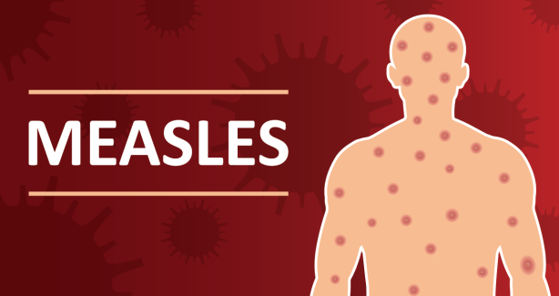 Make sure everyone in your household is up to date on the MMR vaccine. Click here to find out more information on measles.